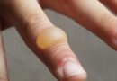 How long does it take a burn blister to heal? How long does it take a burn blister to heal?